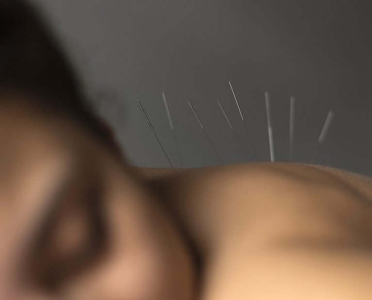 close-up-patient-acupuncture-procedure